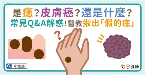 突然長痣|是痣？還是皮膚癌？皮膚科醫師教你揪出「假的痣」，。